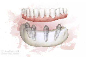 Имплантация зубов по технологии ALL ON 4